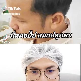 สักไรผมมา แล้วเป็นปื้นดำ !!!
ดูคลิปนี้ให้จบนะครับ 
#bangkokhairtranplant #รีวิวปลูกผม #ปลูกผม #ปลูกผ