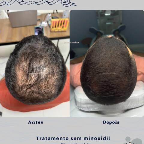 Muita gente só percebe o quanto o cabelo afinou quando vê uma foto tirada de cima… com a luz batendo