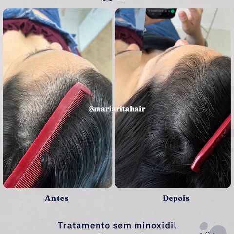 Você já percebeu aqueles fiozinhos novos aparecendo na entrada do cabelo…

Mas os meses passam e ele