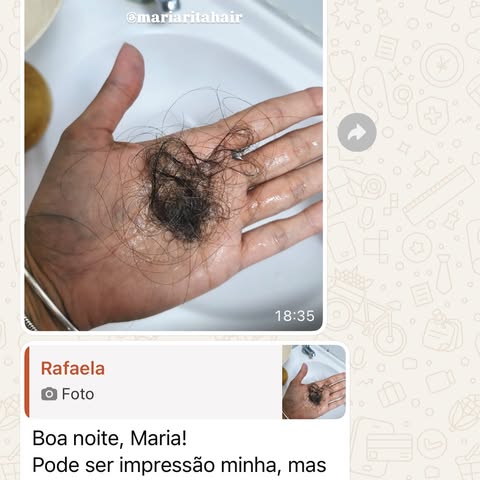 Você já chorou no banho por causa da quantidade de cabelo que estava caindo?

Essa paciente sim.

El