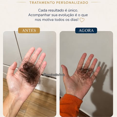 A queda de cabelo vai muito além dos fios.

É o susto toda vez que você lava o cabelo. É olhar para 