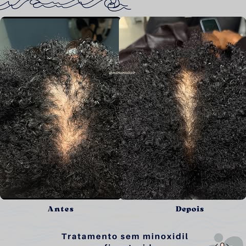 Você olha para o seu couro cabeludo e pensa: “será que ainda dá para recuperar?” 🥹

Esse resultado 