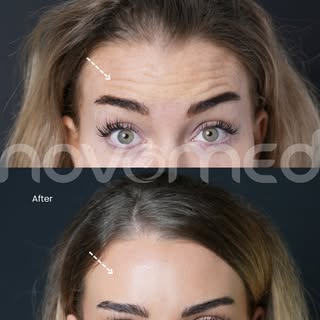 Time for your botox refresh 😉 A little upper-face Botox to soften your fine lines and wrinkles and 