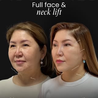 This is your sign to consider the lift 👀 A full facelift helps bring back a younger, more defined v