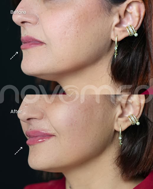 The side profile tells you everything! Better symmetry, better shape, better proportions 💋

@dr.nib