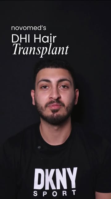 6 months later and the difference is hard to miss 👀 DHI Hair Transplant with a full plan built arou