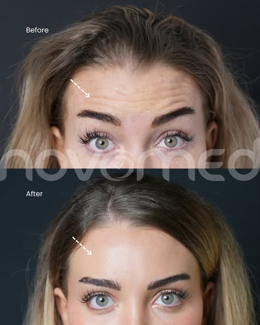 Nothing a little Botox can’t fix 🤭 Upper face Botox helps soften forehead lines, frown lines and cr