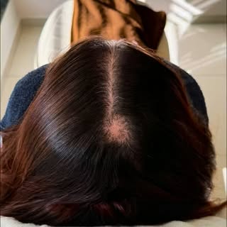 Está com uma falha no couro cabeludo? A biópsia pode ajudar a identificar a causa da queda de cabelo