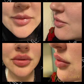 💋 Dite addio alle vecchie asimmetrie: Trasformazione Filler Labbra!
Spesso, ottenere labbra perfett