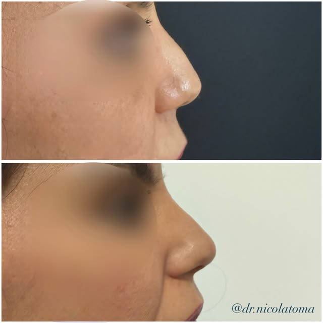 Rinofiller 💉 Ridefinire i volumi e correggere le piccole imperfezioni del profilo in pochi minuti s
