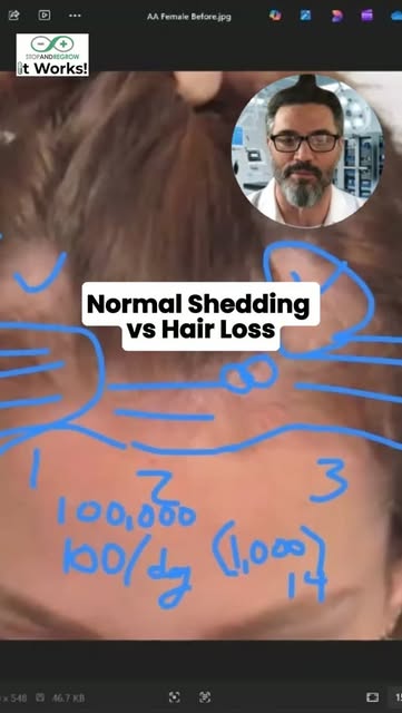 Normal Shedding vs Hair Loss.

www.stopandregrow.com

#foodsmedicine #hairlossformen #testimonials  