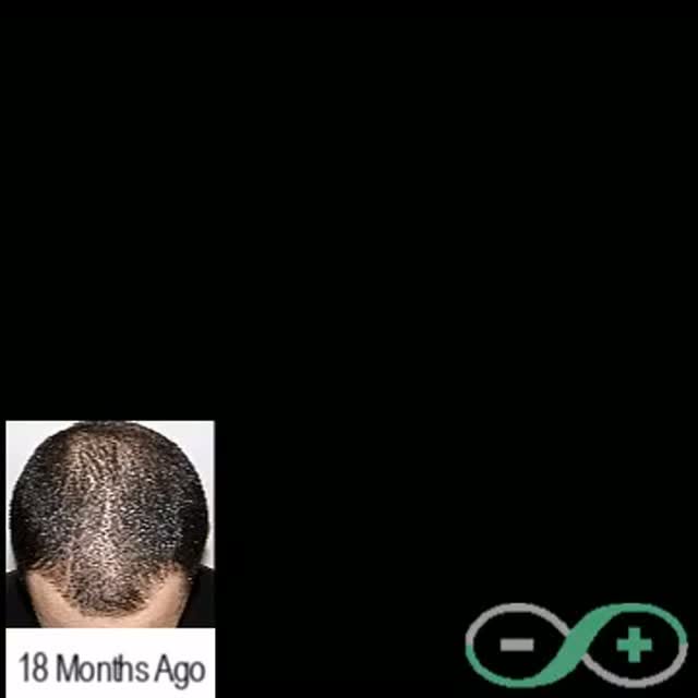 Zack has been on the Stop and Regrow program for 18 months and went from going bald to loving his ha