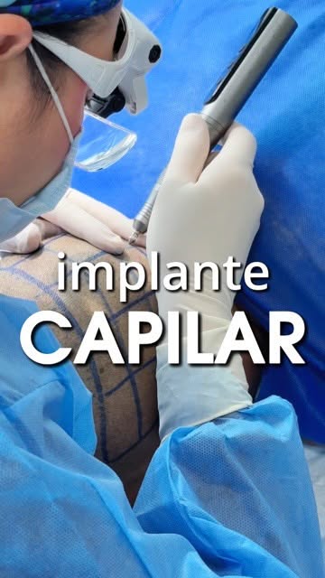 El éxito de un implante capilar no solo depende de la precisión médica, ¡también depende de tus cuid