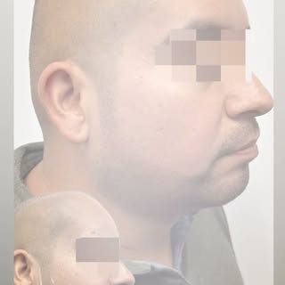 If you’re struggling with a patchy beard or no beard, Beard Micropigmentation is the solution. 
.
In