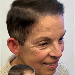 Struggling with thinning hair? While transplants, PRP, or hair fibers might help, they don’t always 