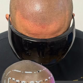 Are you experiencing hair loss or noticing thinning hair? You’re not alone—and there’s a solution. S