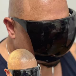 This gentleman came to us as a referral from a happy client. He had a failed hair transplant, leavin