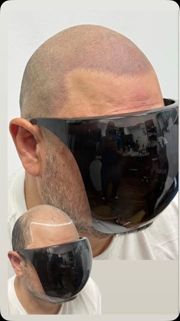 What if the confidence you’ve been missing started with a sharper, fuller-looking hairline? Are you 