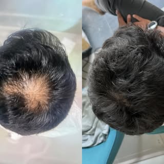 Tratamiento con Células Madre, antes y después! 👍 La importancia de la Evalución tricoscópica 🔍  E
