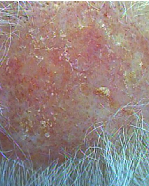 Scalp inflammation isn't always temporary.

Discoid Lupus Erythematosus (DLE) is a chronic autoimmun