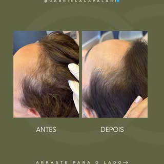 A perda capilar vai muito além da aparência.
Ela afeta autoestima, confiança e a forma como a pessoa