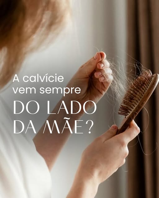 A genética da calvície é mais complexa do que "vem da mãe".

Este post tem caráter informativo e não