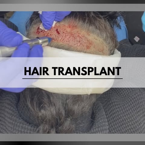 A safe and long-term solution for balding or thinning hair. We are able to do this in-office, comfor