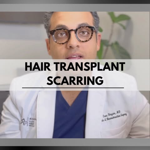 What other questions do you have about hair transplants?
.
.
.
.
🚘 ⁣⁣⁣
Avance Plastic Surgery Insti