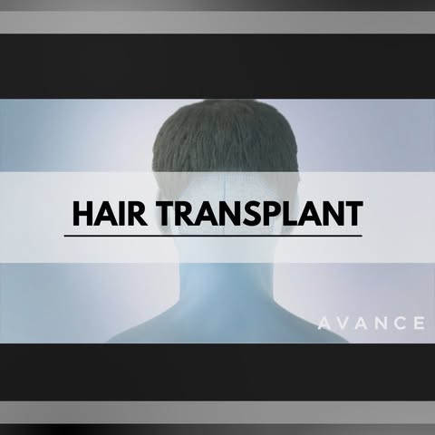 During an FUE hair transplant, a surgeon makes tiny circular incisions to extract donor hair from th