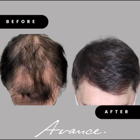During an FUE hair transplant, a surgeon makes tiny circular incisions to extract donor hair from th