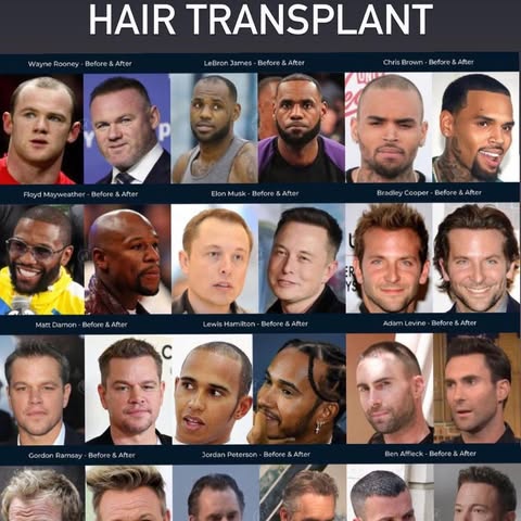 Makes quite a difference doesn’t it? Celebrities with #hairtransplant #beforeandafter 
.⁣⁣
.⁣⁣
🚘 ⁣⁣