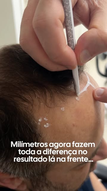 Todo transplante capilar tem um dia em que deixa de ser uma ideia e começa a se tornar realidade.

P