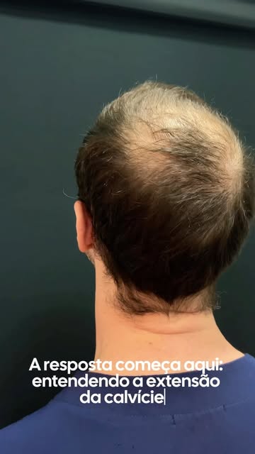 Quando a calvície já avançou em diferentes regiões, querer preencher tudo com a mesma densidade pode