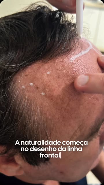 Neste caso, a calvície avançou na região frontal e também na coroa, duas áreas importantes disputand