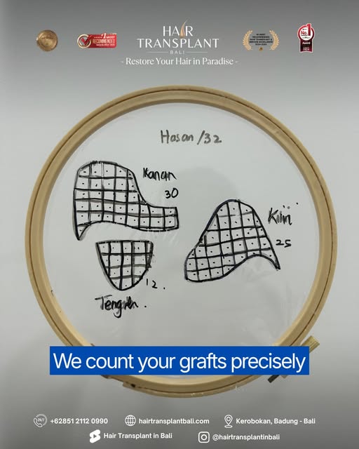 Every graft matters. So does your donor area.

At Hair Transplant Bali, we don’t believe in taking a