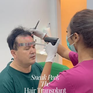 A closer look at what happens behind the scenes.

Here’s a sneak peek of a Hair Transplant procedure