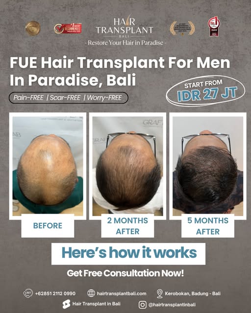FUE Hair Transplant for Men in Paradise, Bali.

A closer look at the transformation: from the initia