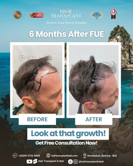 6 months after FUE — visible progress, real results.

This before-and-after comparison shows early h