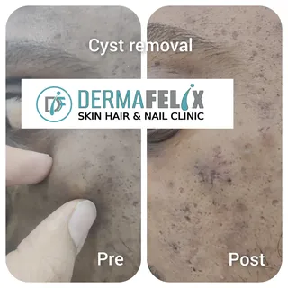 Epidermal inclusion cyst appear as a bump on skin surface. They are fluid filled pocket containing k