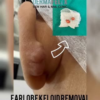 Earlobes are the common site for keloid formation following ear piercing or trauma.  They are benign