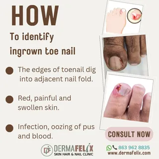 Ingrown toe nail occurs when side of nail grows into  around the nail. Break the vicious cycle of cu