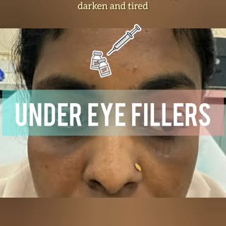 Tear trough deformity is visible indentation under the eyes which makes the eyes appear sunken, dark