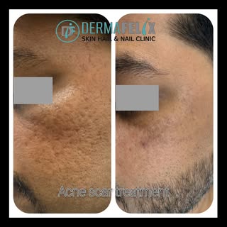 Don't let your past acne define today's confidence. ✨
Acne scars can be a stubborn reminder of past 