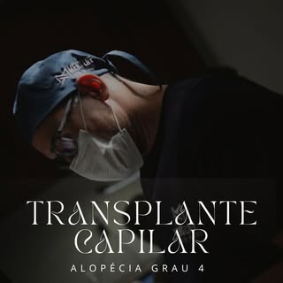 Cada fio implantado segue um estudo personalizado do seu rosto.

Aqui, o transplante capilar é trata