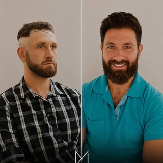 6 meses  apenas após o transplante capilar. Sem raspar. Com resultado natural.

A técnica My Hair fo