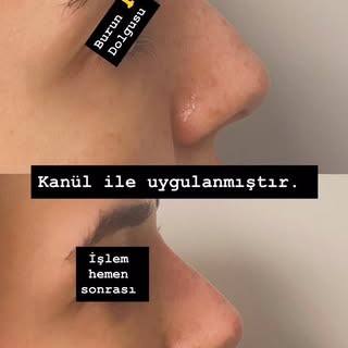 @dr.zafergokdemir 
📍 Şişli 

##burundolgusu #nosefiller #nosejobbeforeandafter #juvederm teosyal 

