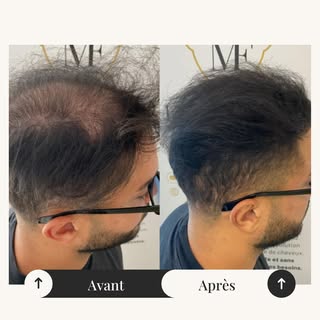 💭 Perte de cheveux, calvitie, cicatrices… et si vous retrouviez enfin confiance en vous ?
Chez MF H