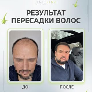 До / после пересадки волос.

Андрогенетическая алопеция V степени: отсутствие линии роста волос и вы