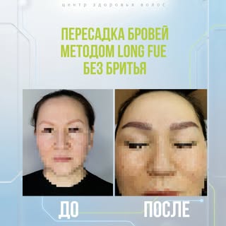 Сегодня в работе — пересадка бровей для прекрасной пациентки.

Перед началом была выполнена разметка