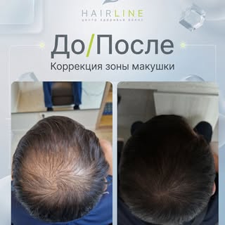 До/После ✨ 
Коррекция зоны макушки 👌🏻

Зона макушки является одной из самых капризных и андроген-ч